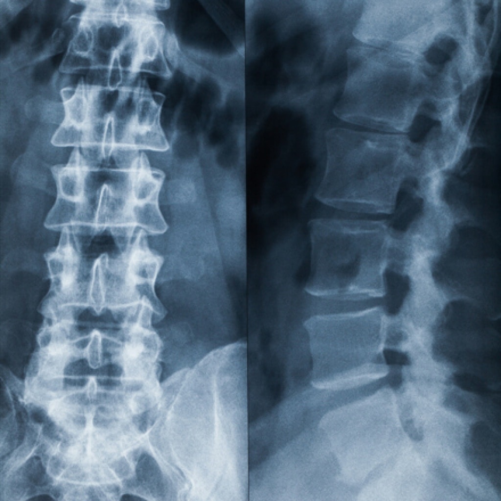 Type 2 Diabetes Drugs and Bone Breaks